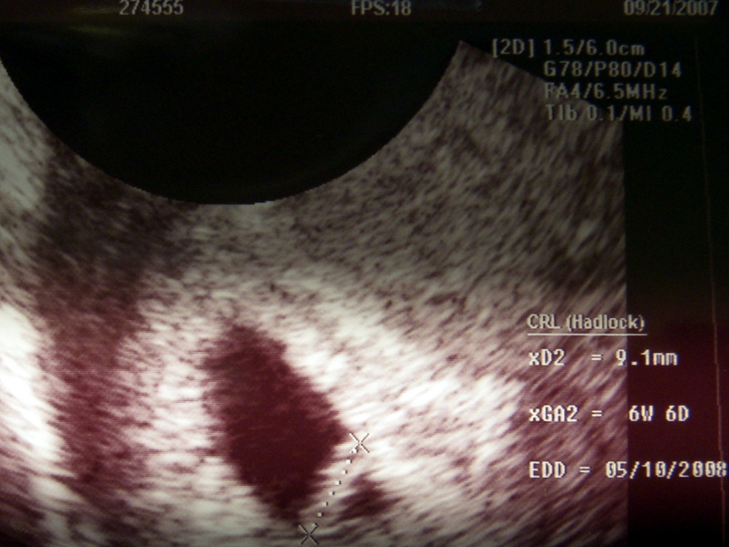 A Work In Progress - Second baby on the way